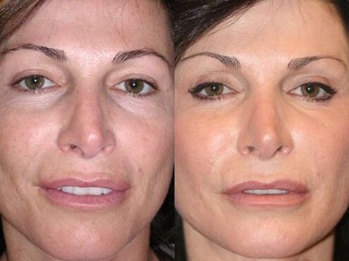 before and after plasma skin resurfacing