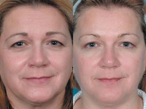 photos before and after plasma skin resurfacing