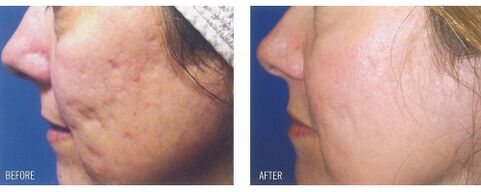 Before and after applying the laser device to scarred skin. 