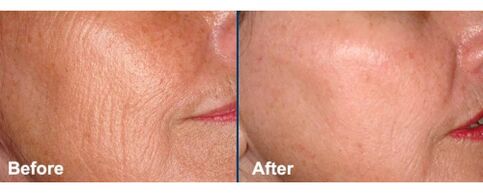 Facial skin before and after the laser resurfacing procedure. 