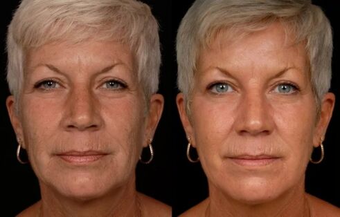 The result of laser treatment of facial skin reduction of wrinkles. 