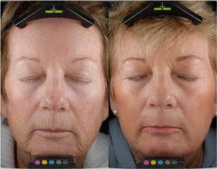 Before and after fractional laser resurfacing