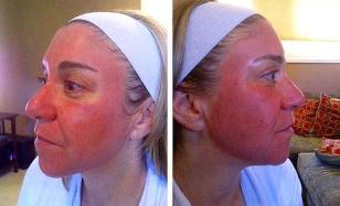 Facial redness after laser resurfacing. 